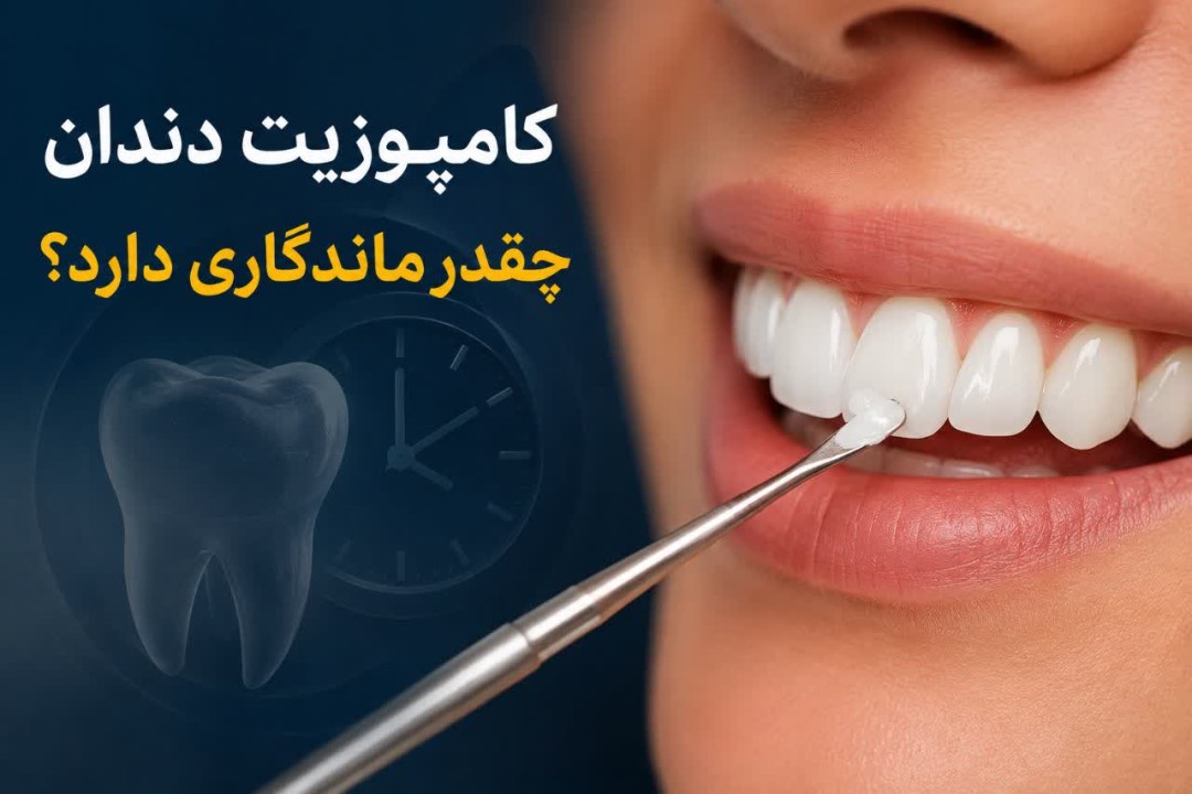 کامپوزیت دندان چقدر ماندگاری دارد؟